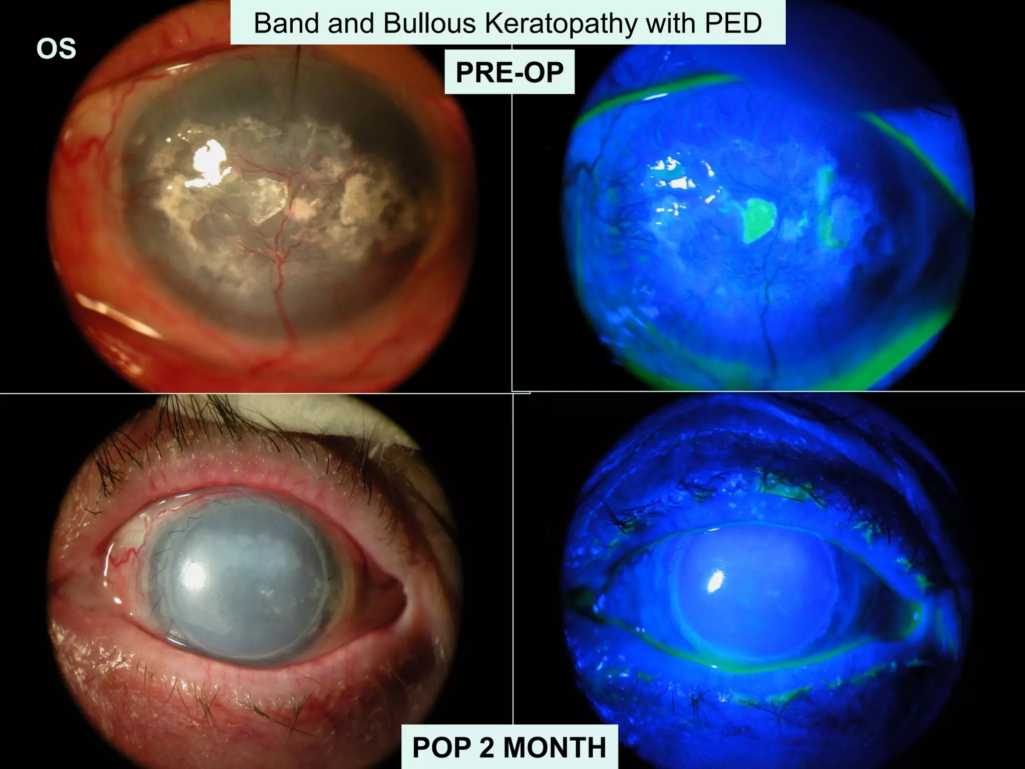 OS
PRE-OP
Band and Bullous Keratopathy with PED
POP 2 MONTH
 