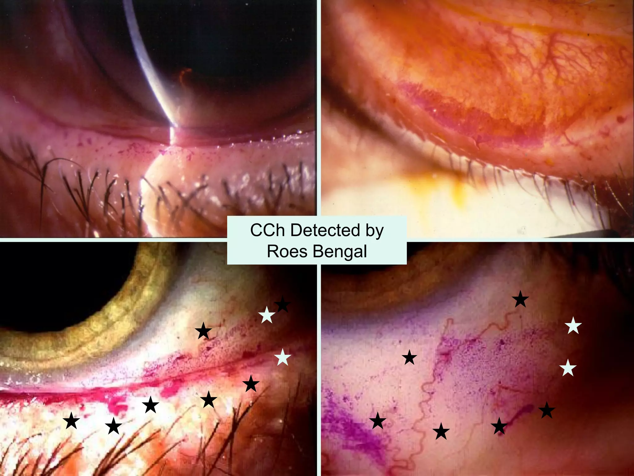 CCh Detected by
Roes Bengal
 