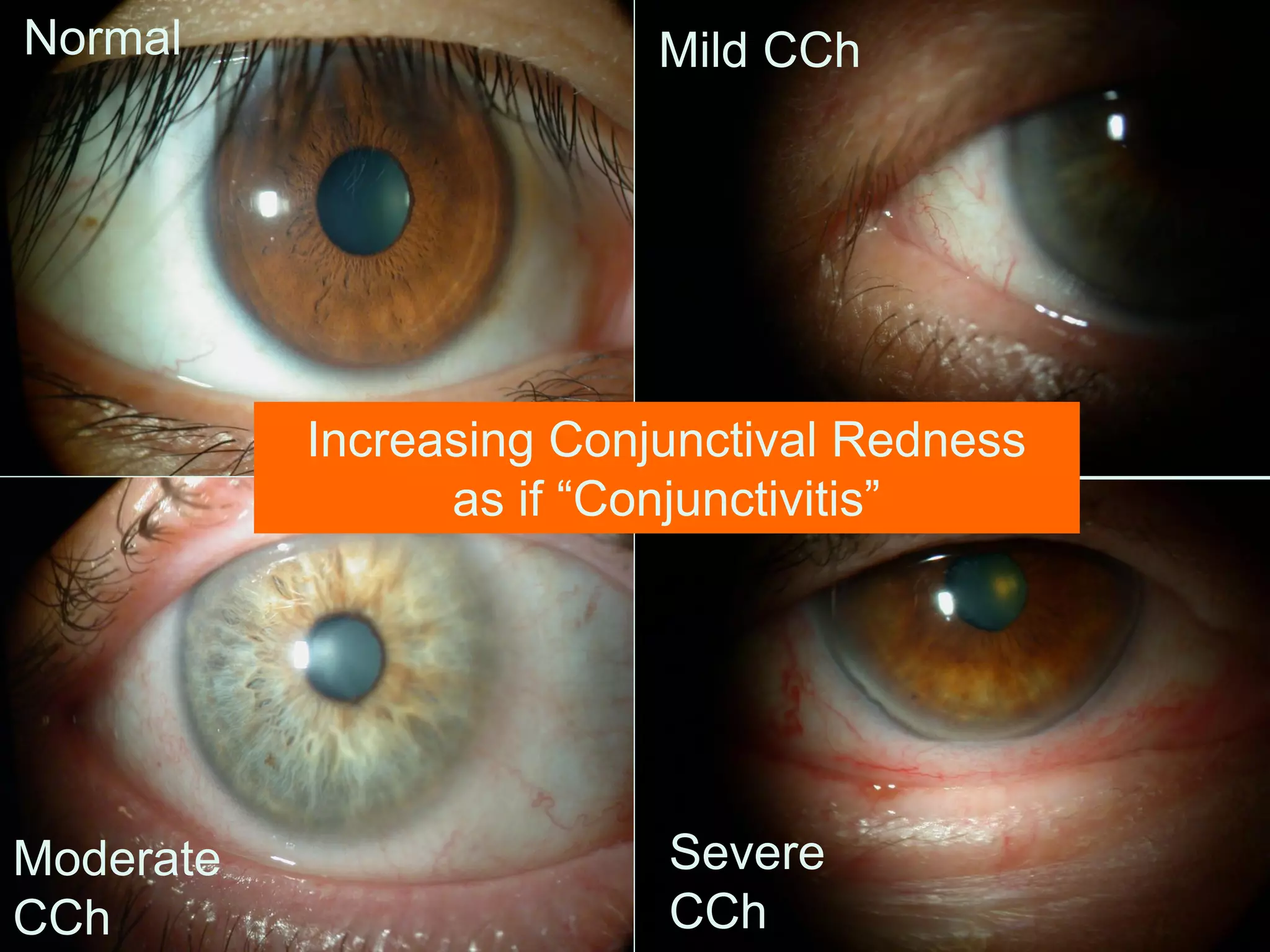 Normal Mild CCh
Moderate
CCh
Severe
CCh
Increasing Conjunctival Redness
as if “Conjunctivitis”
 