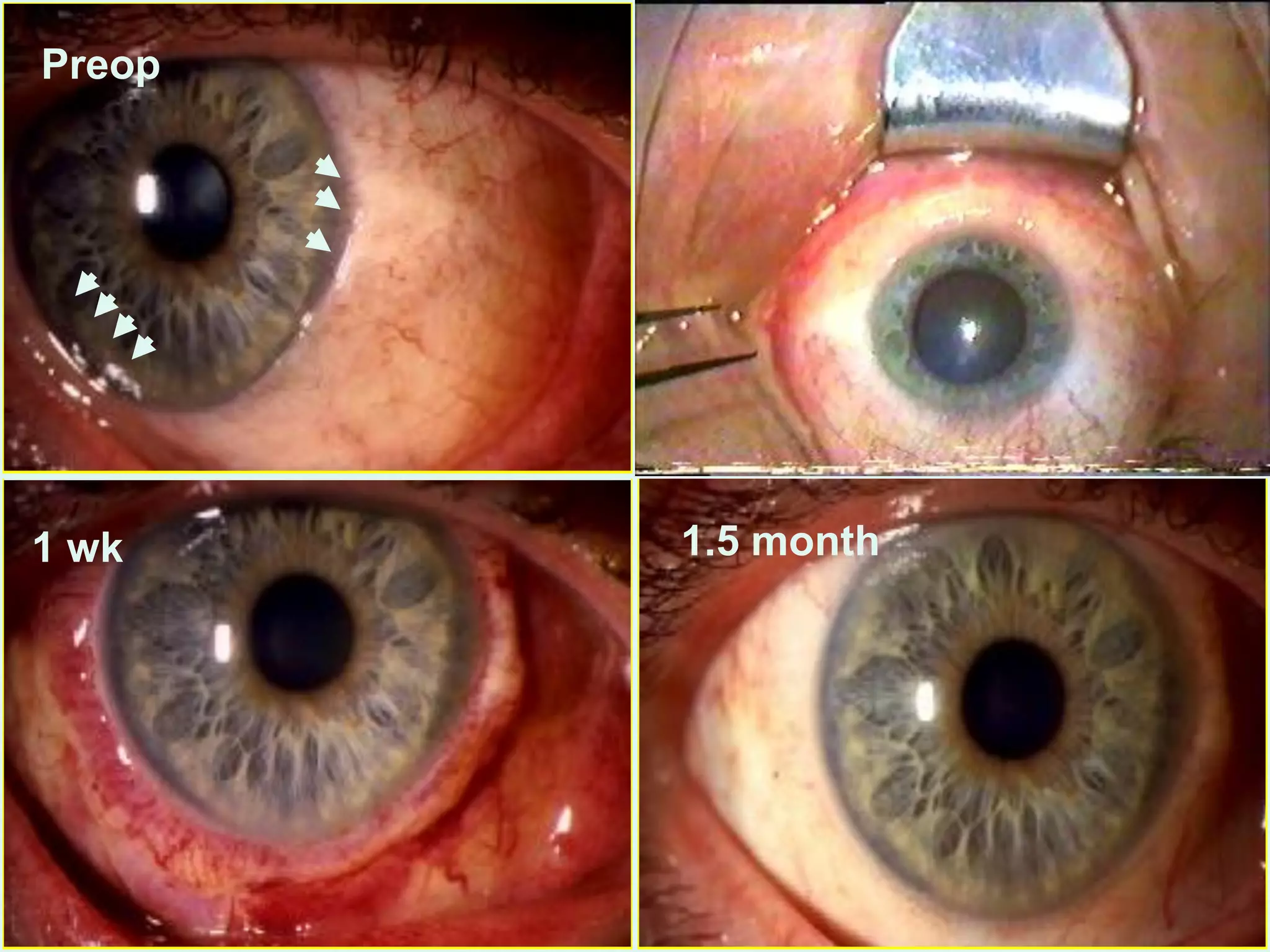 Preop
1 wk 1.5 month
 