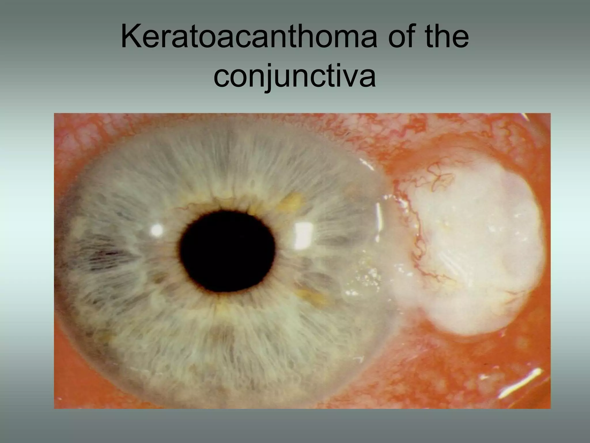 Keratoacanthoma of the
conjunctiva
 