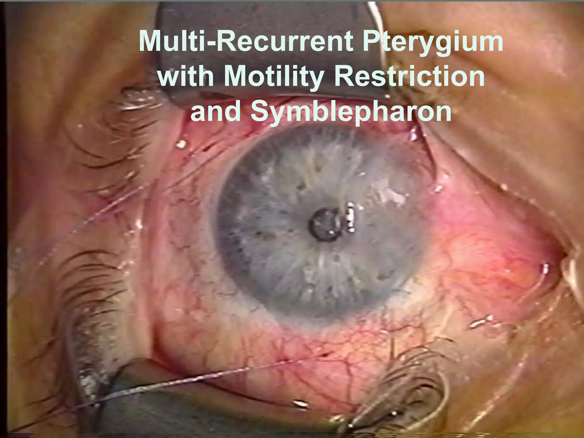 Multi-Recurrent Pterygium
with Motility Restriction
and Symblepharon
 