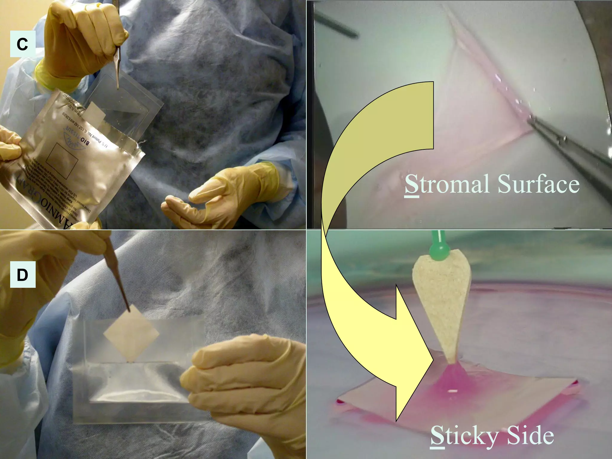 Stromal Surface
Sticky Side
C
D
 