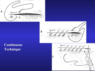 Continuous 
Technique 
 
