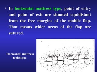 • In horizontal mattress type, point of entry 
and point of exit are situated equidistant 
from the free margins of the mobile flap. 
That means wider areas of the flap are 
sutured. 
Horizontal mattress 
technique 
 