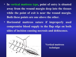 • In vertical mattress type, point of entry is situated 
away from the wound margin deep into the tissues 
while the point of exit is near the wound margin. 
Both these points are one above the other. 
• Horizontal mattress suture if improperly used 
compromise blood supply to the flap edge on both 
sides of incision causing necrosis and dehiscence. 
Vertical mattress 
technique 
 