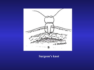 Surgeon’s knot 
 