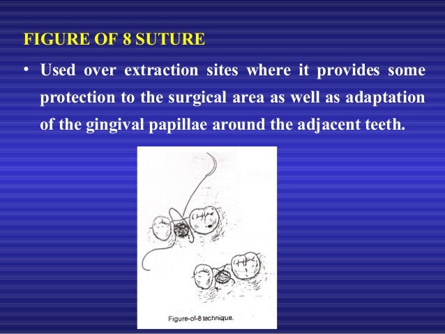 used material nylon suture Suture material used material nylon suture Suture material