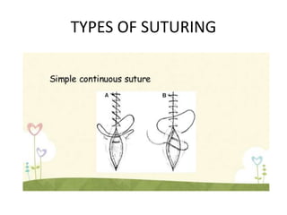TYPES OF SUTURING
 