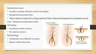 Subcuticular Stitch R SUTURE MATERIAL AND SUTURING TECHNIQUES p(0).pptx