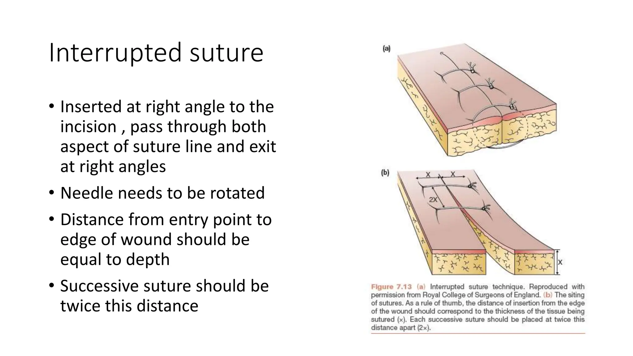 Interrupted suture
• Inserted at right angle to the
incision , pass through both
aspect of suture line and exit
at right angles
• Needle needs to be rotated
• Distance from entry point to
edge of wound should be
equal to depth
• Successive suture should be
twice this distance
 