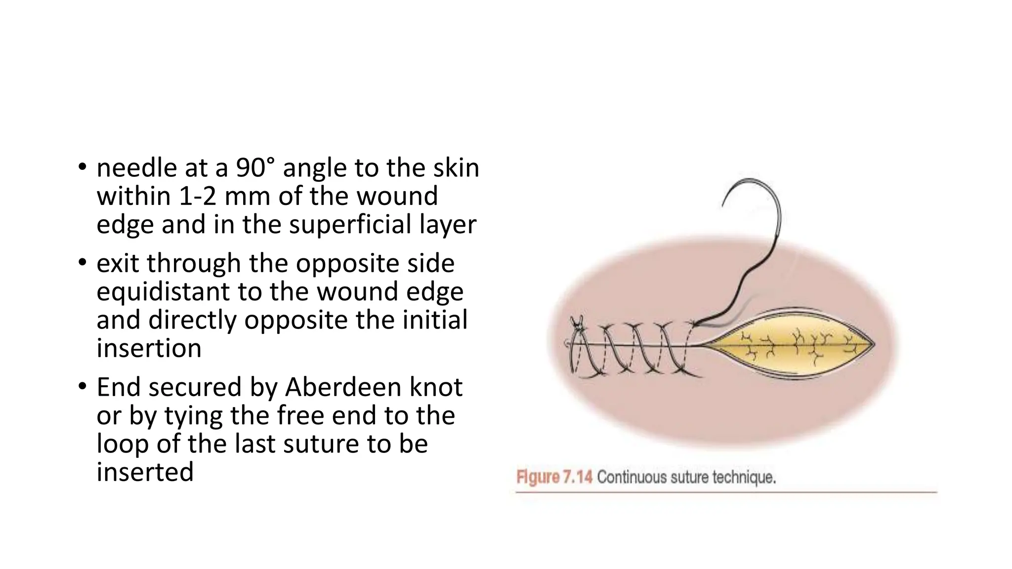 • needle at a 90° angle to the skin
within 1-2 mm of the wound
edge and in the superficial layer
• exit through the opposite side
equidistant to the wound edge
and directly opposite the initial
insertion
• End secured by Aberdeen knot
or by tying the free end to the
loop of the last suture to be
inserted
 