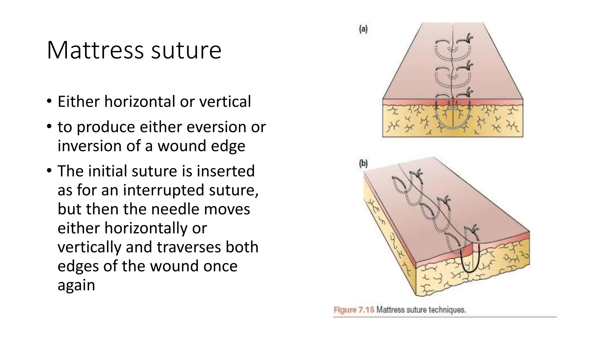 Mattress suture
• Either horizontal or vertical
• to produce either eversion or
inversion of a wound edge
• The initial suture is inserted
as for an interrupted suture,
but then the needle moves
either horizontally or
vertically and traverses both
edges of the wound once
again
 