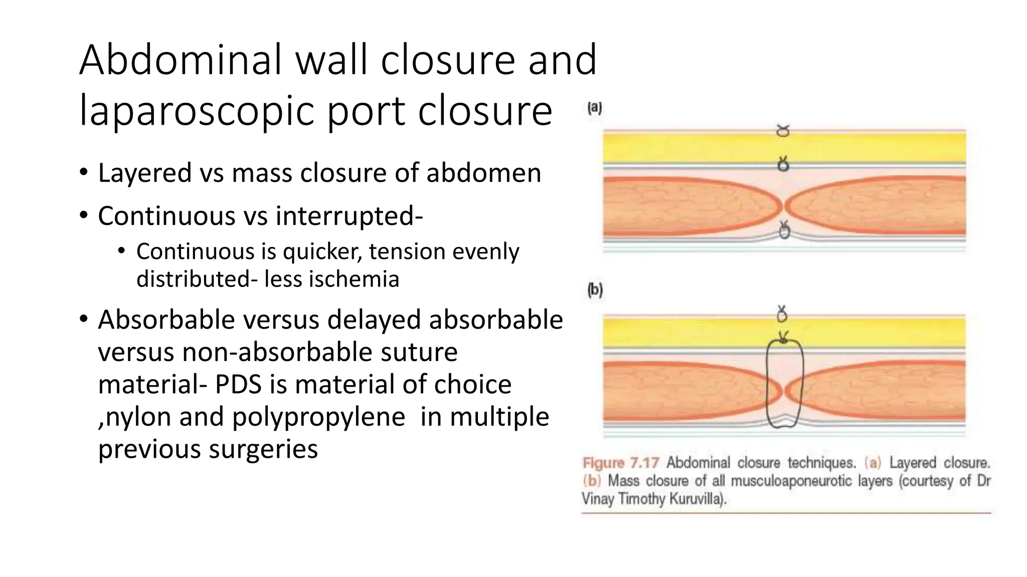 Abdominal wall closure and
laparoscopic port closure
• Layered vs mass closure of abdomen
• Continuous vs interrupted-
• Continuous is quicker, tension evenly
distributed- less ischemia
• Absorbable versus delayed absorbable
versus non-absorbable suture
material- PDS is material of choice
,nylon and polypropylene in multiple
previous surgeries
 
