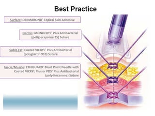 Surface: DERMABOND®
Topical Skin Adhesive
Dermis: MONOCRYL*
Plus Antibacterial
(poliglecaprone 25) Suture
SubQ-Fat: Coated VICRYL*
Plus Antibacterial
(polyglactin 910) Suture
Fascia/Muscle: ETHIGUARD*
Blunt Point Needle with
Coated VICRYL Plus or PDS*
Plus Antibacterial
(polydioxanone) Suture
 