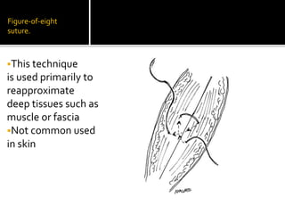 Figure-of-eight
suture.
This technique
is used primarily to
reapproximate
deep tissues such as
muscle or fascia
Not common used
in skin
 