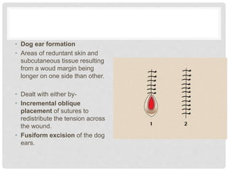 • Dog ear formation
• Areas of reduntant skin and
subcutaneous tissue resulting
from a woud margin being
longer on one side than other.
• Dealt with either by-
• Incremental oblique
placement of sutures to
redistribute the tension across
the wound.
• Fusiform excision of the dog
ears.
 
