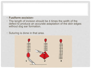 • Fusiform excision-
• The length of incision should be 4 times the width of the
defect to produce an accurate adaptation of the skin edges
without dog ear formation.
• Suturing is done in that area.
 