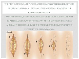 THE FIRST SUTURE WILL BE PLACED AT EITHER APEX OF THE ELLIPSE. SUTURES
ARE THEN PLACED IN AN ALTERNATING PATTERN APPROACHING THE
CENTRE OF THE DEFECT.
WITH EACH SUBSEQUENT SUTURE PLACEMENT, THE SURGEON WILL BE ABLE
TO APPRECIATE REDUCTION OF TENSION AT THE CENTRE OF THE WOUND
AND CAN THEREFORE MINIMIZE THE AMOUNT OF UNDERMINING THAT IS
NECESSARY FOR APPROXIMATION.
 