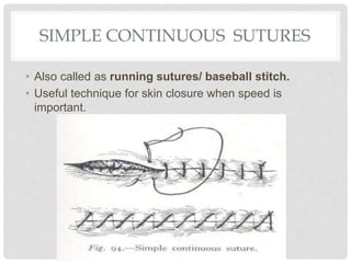 SIMPLE CONTINUOUS SUTURES
• Also called as running sutures/ baseball stitch.
• Useful technique for skin closure when speed is
important.
 