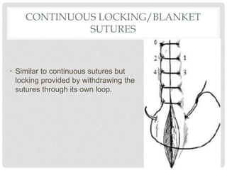 CONTINUOUS LOCKING/BLANKET
SUTURES
• Similar to continuous sutures but
locking provided by withdrawing the
sutures through its own loop.
 