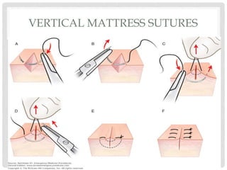 VERTICAL MATTRESS SUTURES
 