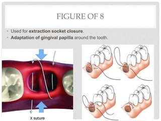 FIGURE OF 8
• Used for extraction socket closure.
• Adaptation of gingival papilla around the tooth.
 