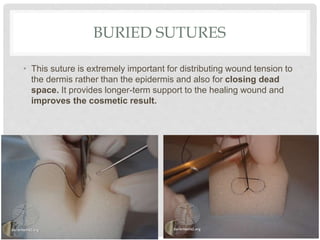 BURIED SUTURES
• This suture is extremely important for distributing wound tension to
the dermis rather than the epidermis and also for closing dead
space. It provides longer-term support to the healing wound and
improves the cosmetic result.
 