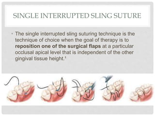 SINGLE INTERRUPTED SLING SUTURE
• The single interrupted sling suturing technique is the
technique of choice when the goal of therapy is to
reposition one of the surgical flaps at a particular
occlusal apical level that is independent of the other
gingival tissue height.¹
 