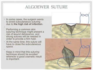 ALGOEWER SUTURE
• In some cases, the surgeon wants
to avoid subcutaneous suturing
due to the high risk of infection.
•
Performing a common skin
suturing technique might present a
risk of wound dehiscence, and
strong sutures will be needed in
order to provide a firm hold.
• At the same time, this suture will
have to close the subcutaneous
space.
•
Keep in mind that this suturing
technique should be avoided
wherever a good cosmetic result
is important.
 