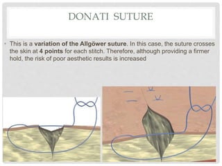 DONATI SUTURE
• This is a variation of the Allgöwer suture. In this case, the suture crosses
the skin at 4 points for each stitch. Therefore, although providing a firmer
hold, the risk of poor aesthetic results is increased
 