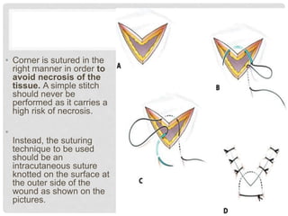 • Corner is sutured in the
right manner in order to
avoid necrosis of the
tissue. A simple stitch
should never be
performed as it carries a
high risk of necrosis.
•
Instead, the suturing
technique to be used
should be an
intracutaneous suture
knotted on the surface at
the outer side of the
wound as shown on the
pictures.
 