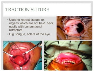 TRACTION SUTURE
• Used to retract tissues or
organs which are not held back
easily with conventional
retractors.
• E.g. tongue, sclera of the eye.
 