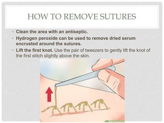 HOW TO REMOVE SUTURES
• Clean the area with an antiseptic.
• Hydrogen peroxide can be used to remove dried serum
encrusted around the sutures.
• Lift the first knot. Use the pair of tweezers to gently lift the knot of
the first stitch slightly above the skin.
 