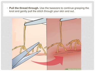 • Pull the thread through. Use the tweezers to continue grasping the
knot and gently pull the stitch through your skin and out.
 