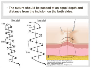 • The suture should be passed at an equal depth and
distance from the incision on the both sides.
 