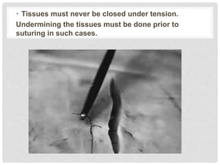 • Tissues must never be closed under tension.
Undermining the tissues must be done prior to
suturing in such cases.
 