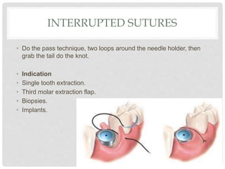 INTERRUPTED SUTURES
• Do the pass technique, two loops around the needle holder, then
grab the tail do the knot.
• Indication
• Single tooth extraction.
• Third molar extraction flap.
• Biopsies.
• Implants.
 