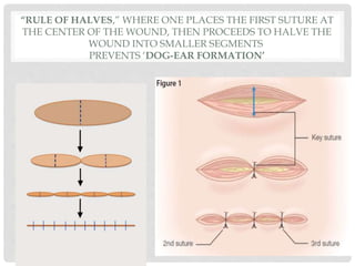 “RULE OF HALVES,” WHERE ONE PLACES THE FIRST SUTURE AT
THE CENTER OF THE WOUND, THEN PROCEEDS TO HALVE THE
WOUND INTO SMALLER SEGMENTS
PREVENTS ‘DOG-EAR FORMATION’
 