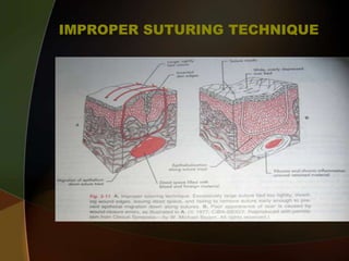 IMPROPER SUTURING TECHNIQUE
 
