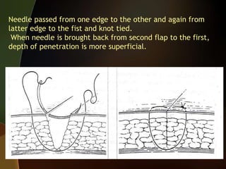 Needle passed from one edge to the other and again from
latter edge to the fist and knot tied.
When needle is brought back from second flap to the first,
depth of penetration is more superficial.
 