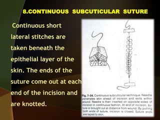 8.CONTINUOUS SUBCUTICULAR SUTURE
Continuous short
lateral stitches are
taken beneath the
epithelial layer of the
skin. The ends of the
suture come out at each
end of the incision and
are knotted.
 