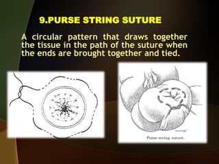 9.PURSE STRING SUTURE
A circular pattern that draws together
the tissue in the path of the suture when
the ends are brought together and tied.
 
