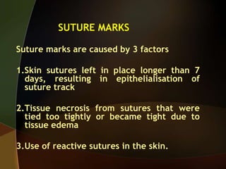 SUTURE MARKS
Suture marks are caused by 3 factors
1.Skin sutures left in place longer than 7
days, resulting in epithelialisation of
suture track
2.Tissue necrosis from sutures that were
tied too tightly or became tight due to
tissue edema
3.Use of reactive sutures in the skin.
 