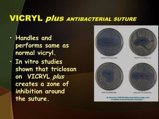 VICRYL plus ANTIBACTERIAL SUTURE
• Handles and
performs same as
normal vicryl.
• In vitro studies
shown that triclosan
on VICRYL plus
creates a zone of
inhibition around
the suture.
 
