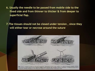 6. Usually the needle to be passed from mobile side to the
fixed side and from thinner to thicker & from deeper to
superficial flap.
7.The tissues should not be closed under tension , since they
will either tear or necrose around the suture
 