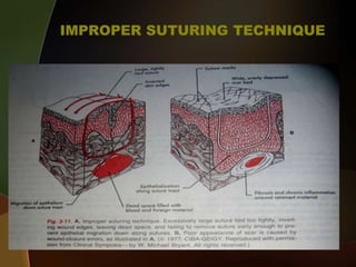 IMPROPER SUTURING TECHNIQUE
 