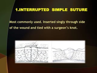 1.INTERRUPTED SIMPLE SUTURE
Most commonly used. Inserted singly through side
of the wound and tied with a surgeon’s knot.
 