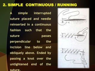 2. SIMPLE CONTINUOUS / RUNNING
A simple interrupted
suture placed and needle
reinserted in a continuous
fashion such that the
suture passes
perpendicular to the
incision line below and
obliquely above. Ended by
passing a knot over the
untightened end of the
suture.
 