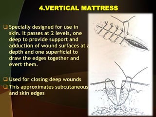 4.VERTICAL MATTRESS
 Specially designed for use in
skin. It passes at 2 levels, one
deep to provide support and
adduction of wound surfaces at a
depth and one superficial to
draw the edges together and
evert them.
 Used for closing deep wounds
 This approximates subcutaneous
and skin edges
 